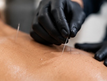 Dry needling